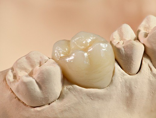same-day cerec dental crown on smile model