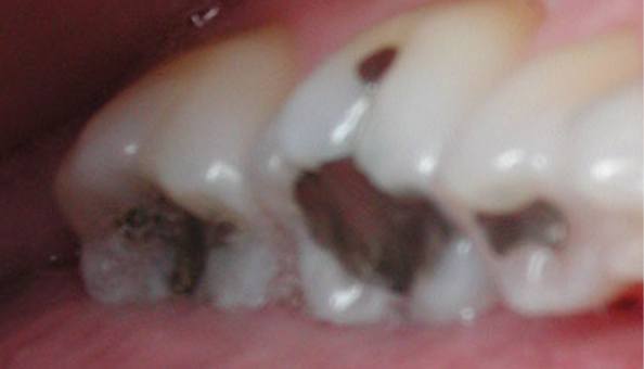 three decayed teeth