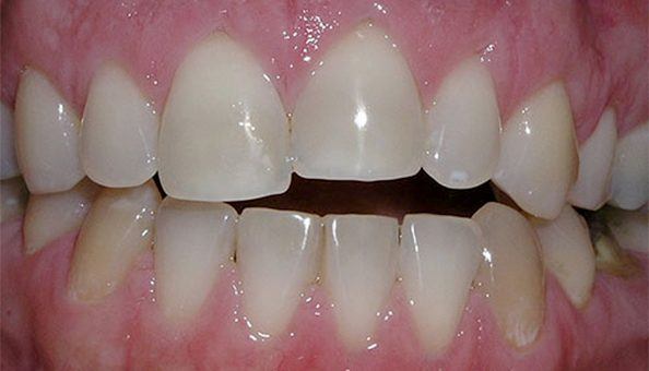 misaligned teeth before correction