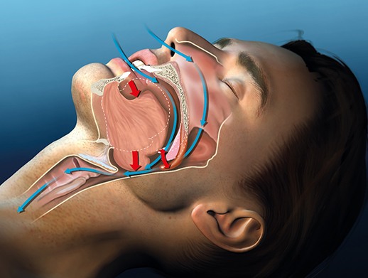 Image of a man’s upper airway.