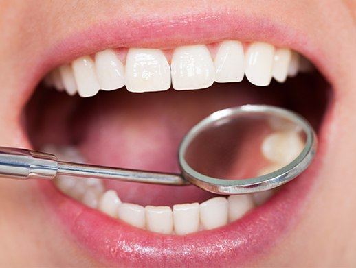 close shot of smile with tooth colored fillings