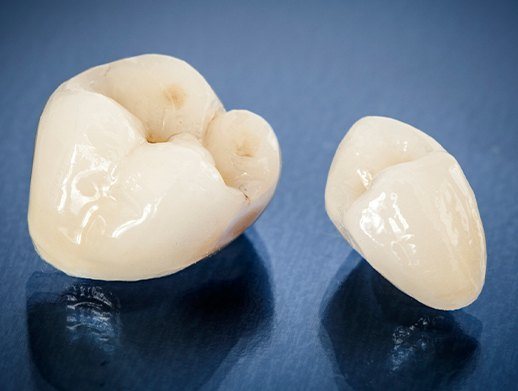 two dental crown examples