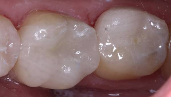 tooth colored fillings