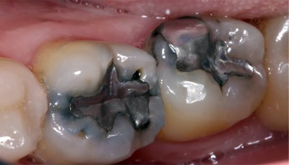 two teeth with silver fillings