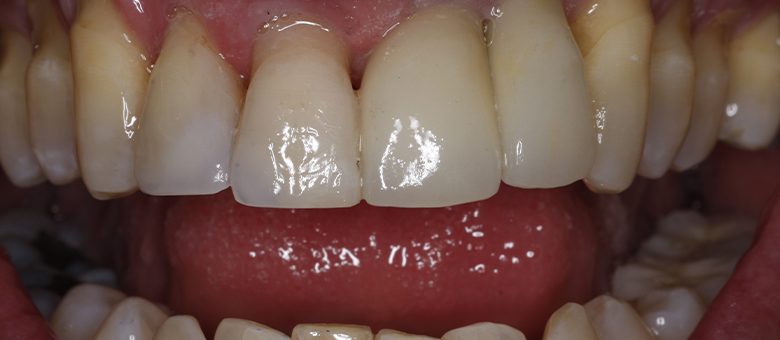 bonded chipped front tooth after