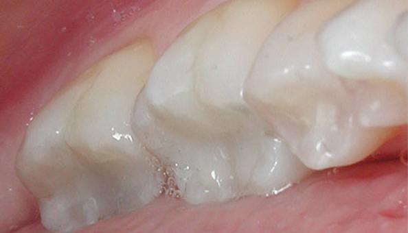 teeth after decay correction