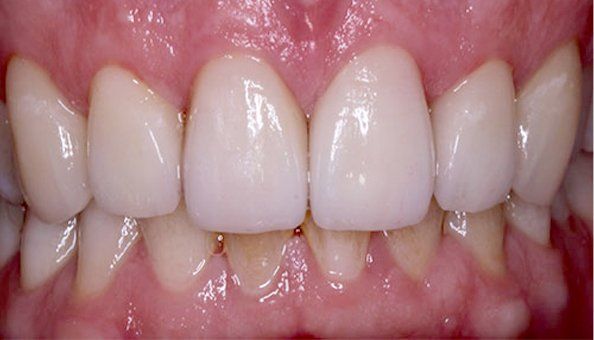 teeth after gap correction
