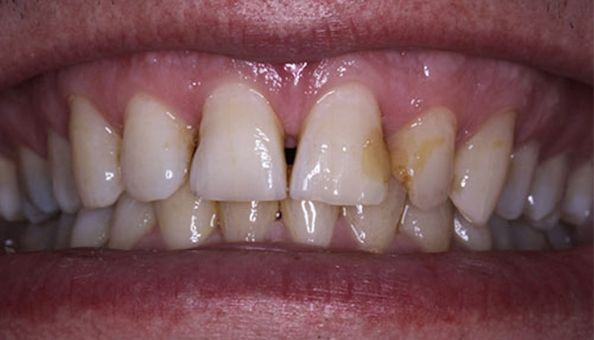 gapped teeth before correction