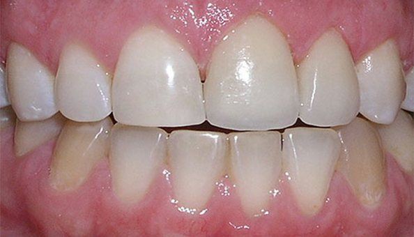 teeth after correcting misalignment