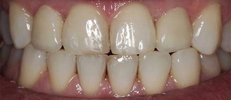 teeth after gaps and chips are corrected
