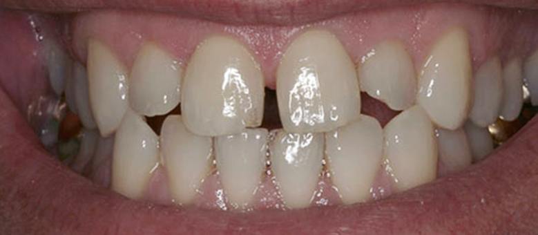 gapped and chipped teeth before correction