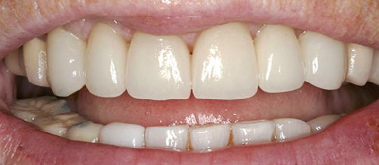 teeth after correcting discoloration and damage