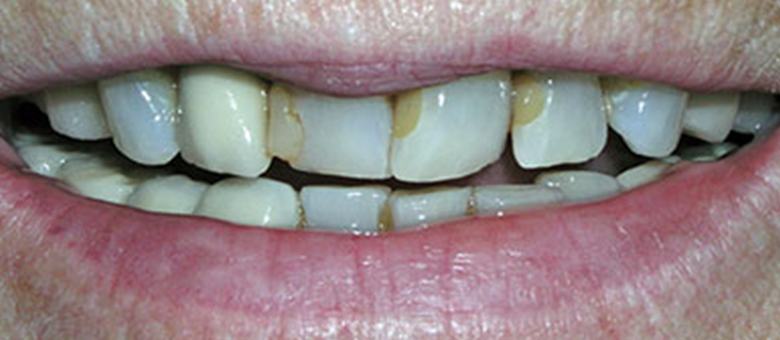 yellowed chipped teeth before correction