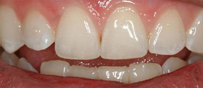 teeth after correcting unevenness