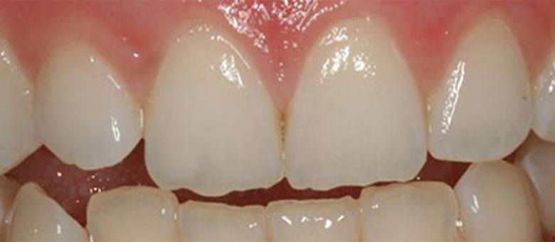 chipped uneven teeth before correction