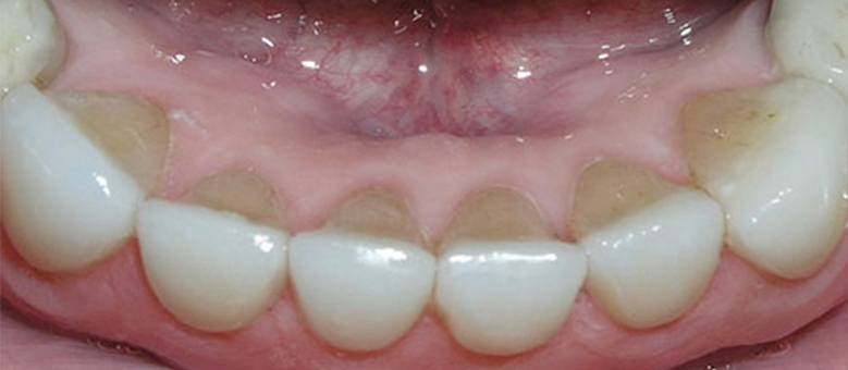 Decay and dental wear repaired
