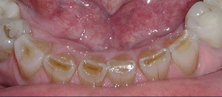 Severe decay and dental wear