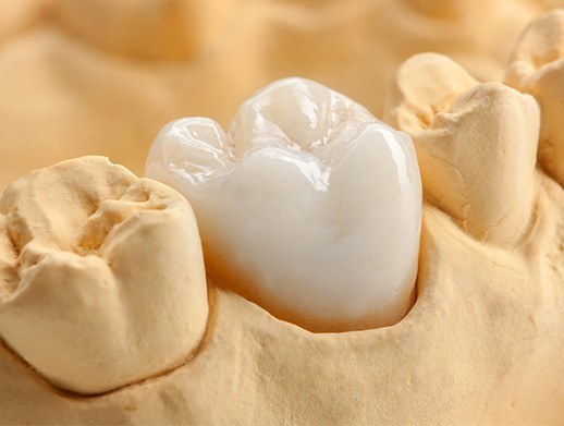 CEREC milled dental crown