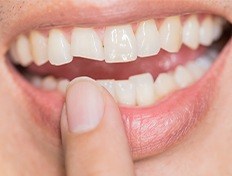 woman pointing to chipped tooth