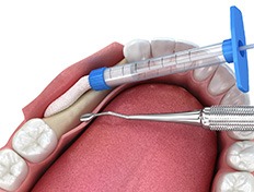 3-D diagram of a bone graft