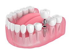 3D render of a dental implant