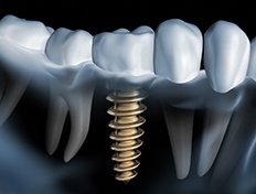 X-ray of a patient with a dental implant 