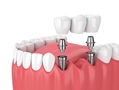 dental implant being placed over two dental implants 