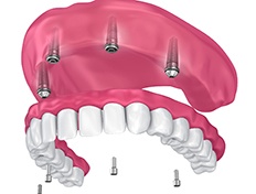 implant denture replacing all of the upper teeth 
