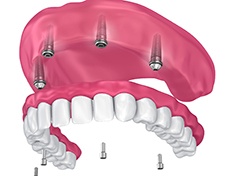 implant denture replacing all of the upper teeth