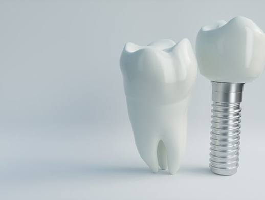 dental implant with crown next to natural tooth
