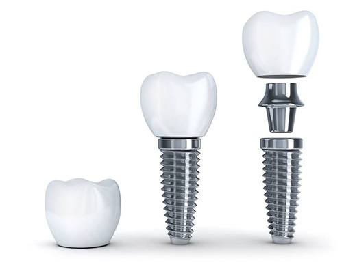 the three parts of a dental implant