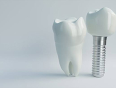 dental implant next to a natural tooth