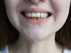 Invisalign can help fix an underbite