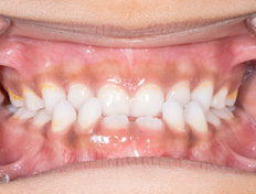 Close an open bite with the help of Invisalign