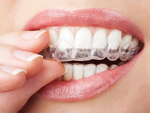 close shot of woman putting in invisalign tray