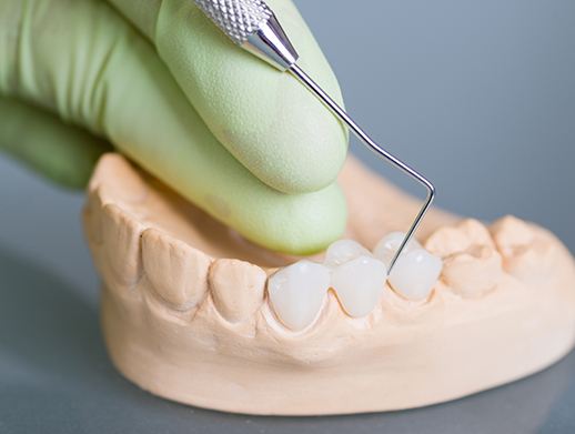 mock up dental bridge