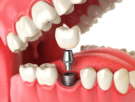 computer illustration of dental implant