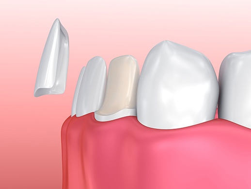 veneer being placed on bottom tooth