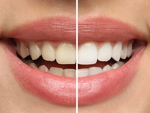 Patient's smile before and after teeth whitening