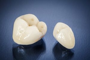 Image of a CEREC crown in Skokie.