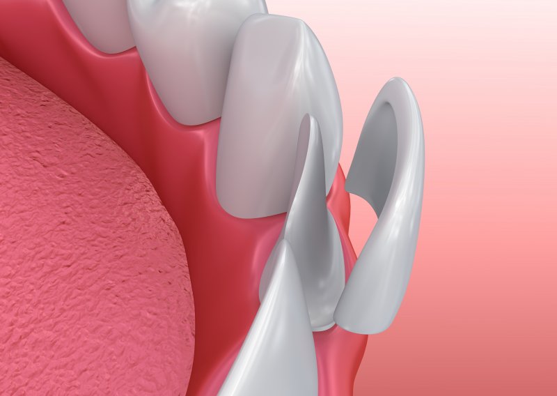 3D illustration of porcelain veneer placement