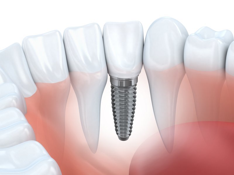 3D rendering of dental implants