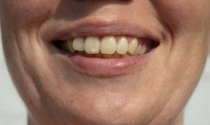A closeup of white spots on the surface of a patient’s teeth