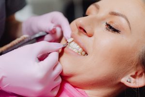 Dentist applying veneer to woman’s tooth