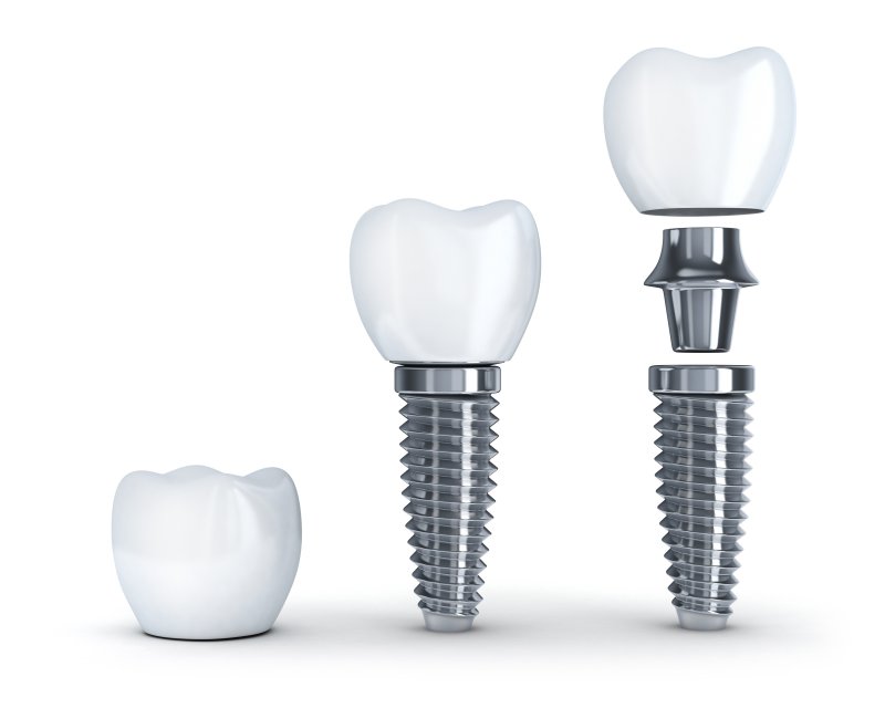 3-D Model of a dental implant
