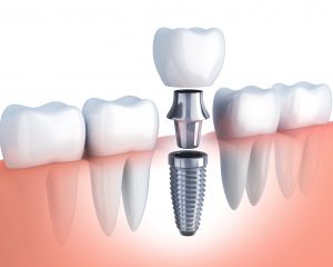 Digital image of single unit dental implant