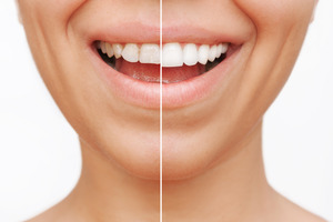 Before and after of a set of veneers