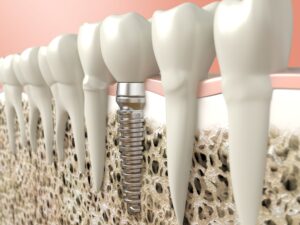 Model of dental implant inserted into jawbone
