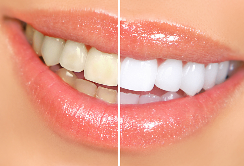 Woman's smile half yellow, half white teeth
