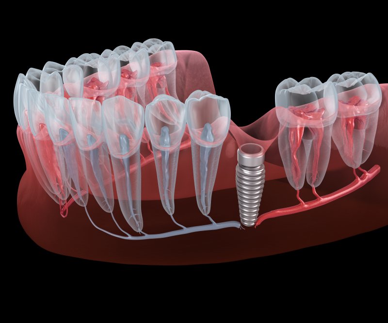 Dental implant in gum tissue